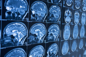 How The Simon Law Group Can Help If You’ve Suffered a Brain Injury in Hermosa Beach, CA
